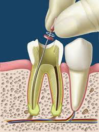 endodoncia