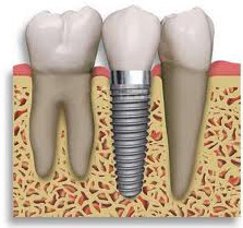 implantes
